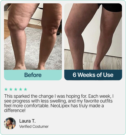 This sparked the change I was hoping for. Each week, I see progress with less swelling, and my favorite outfits feel more comfortable. NeoLipex has truly made a difference!